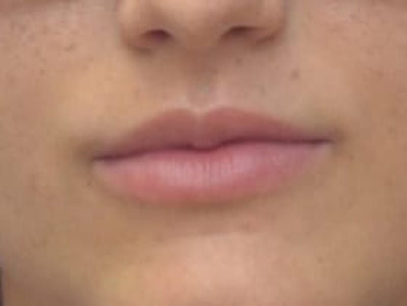Lip Augmentation Before & After Gallery - Patient 410269 - Image 1