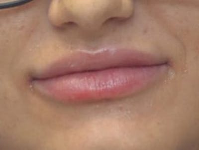 Lip Augmentation Before & After Gallery - Patient 410269 - Image 2