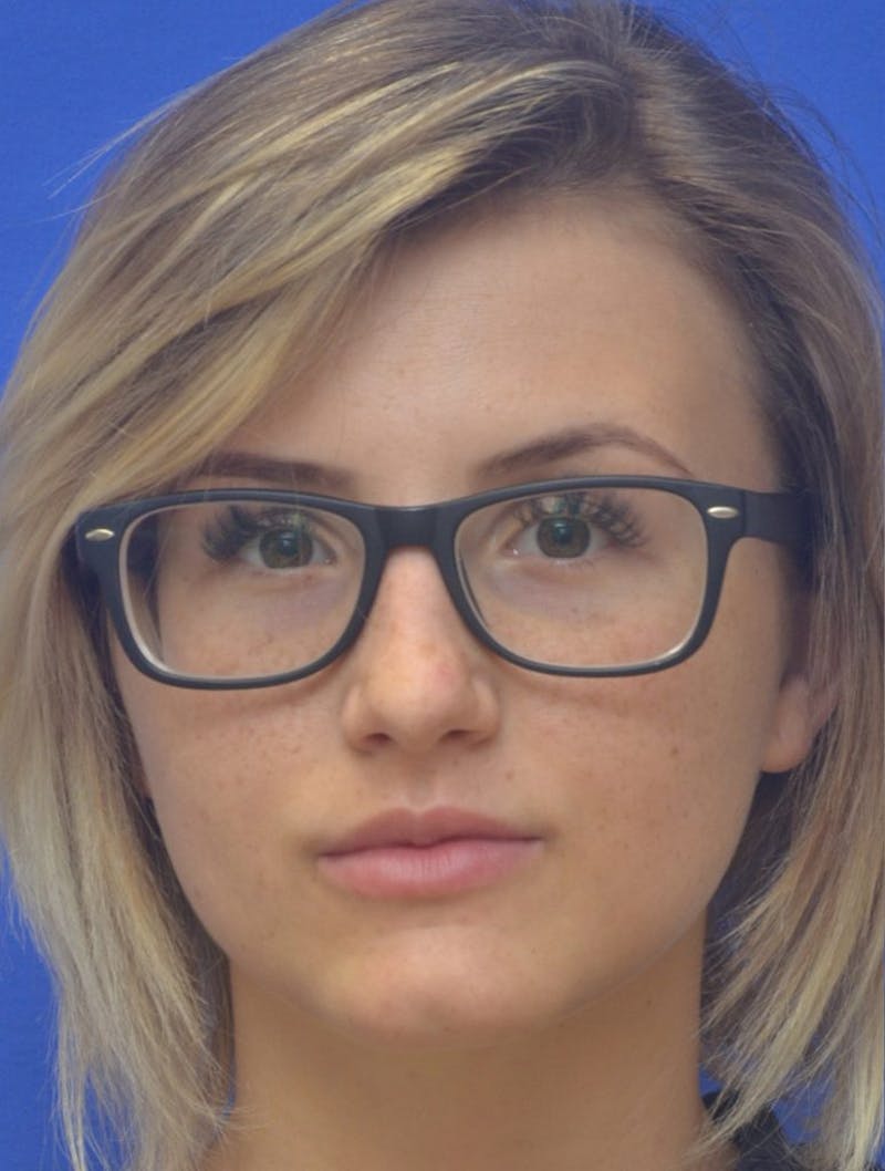 Lip Augmentation Before & After Gallery - Patient 410269 - Image 3