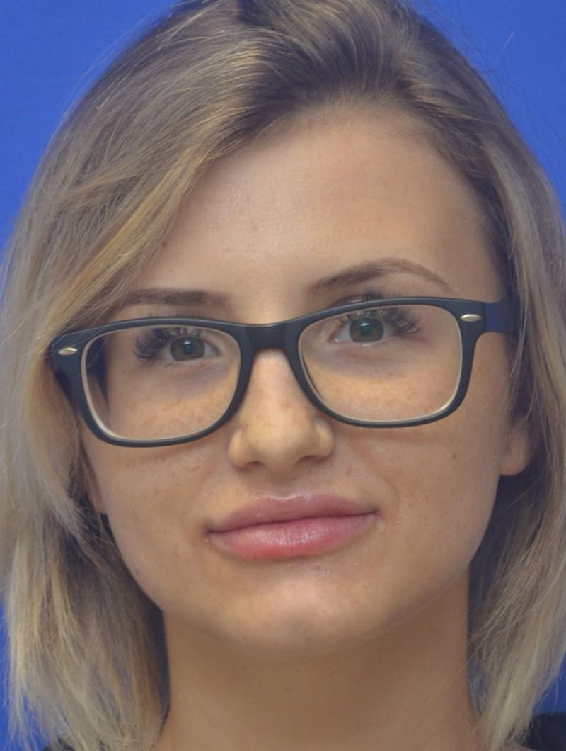 Lip Augmentation Before & After Gallery - Patient 410269 - Image 4