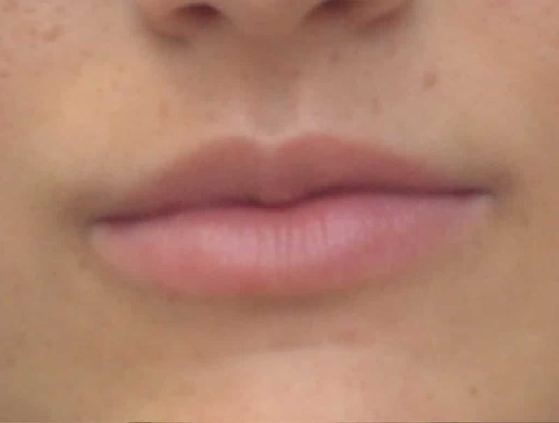 Lip Augmentation Before & After Gallery - Patient 410269 - Image 5