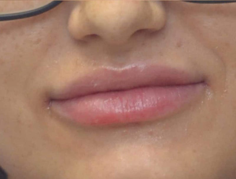 Lip Augmentation Before & After Gallery - Patient 410269 - Image 6