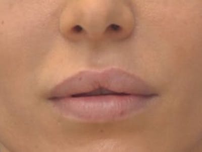 Lip Augmentation Before & After Gallery - Patient 144889 - Image 1
