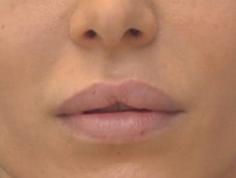 Lip Augmentation Before & After Gallery - Patient 144889 - Image 1