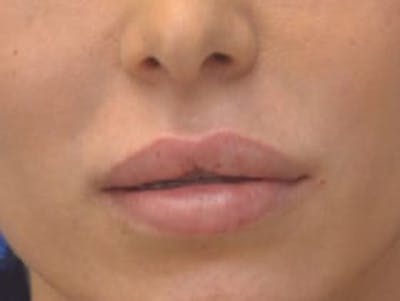 Lip Augmentation Before & After Gallery - Patient 144889 - Image 2