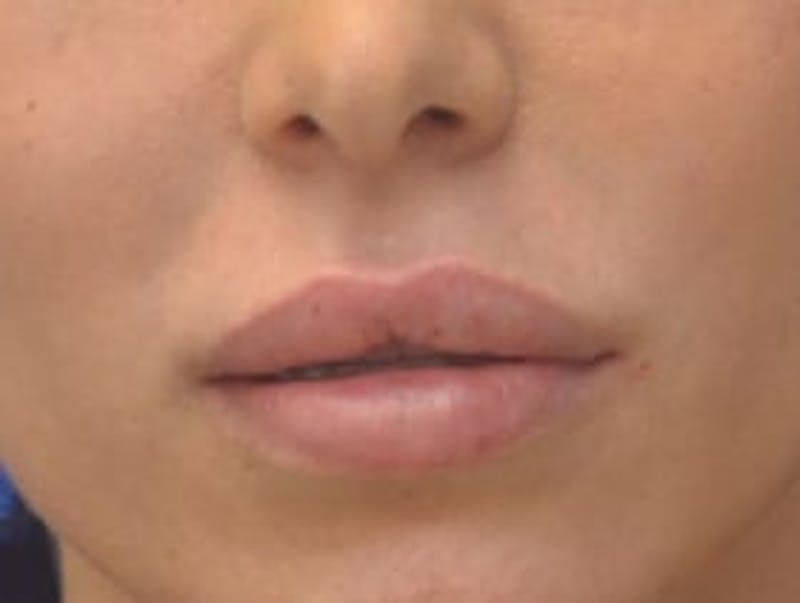 Lip Augmentation Before & After Gallery - Patient 144889 - Image 2