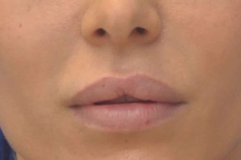 Lip Augmentation Before & After Gallery - Patient 144889 - Image 3