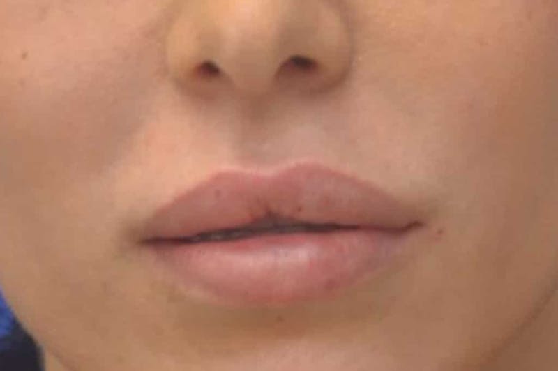 Lip Augmentation Before & After Gallery - Patient 144889 - Image 4