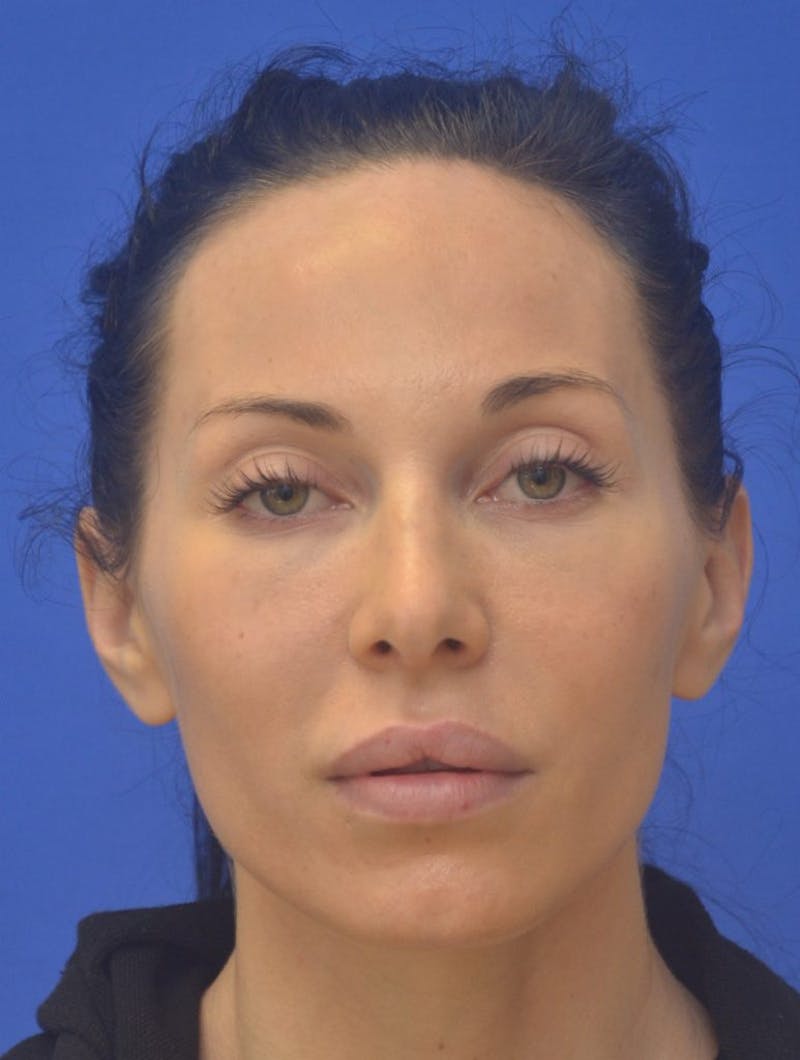 Lip Augmentation Before & After Gallery - Patient 144889 - Image 5