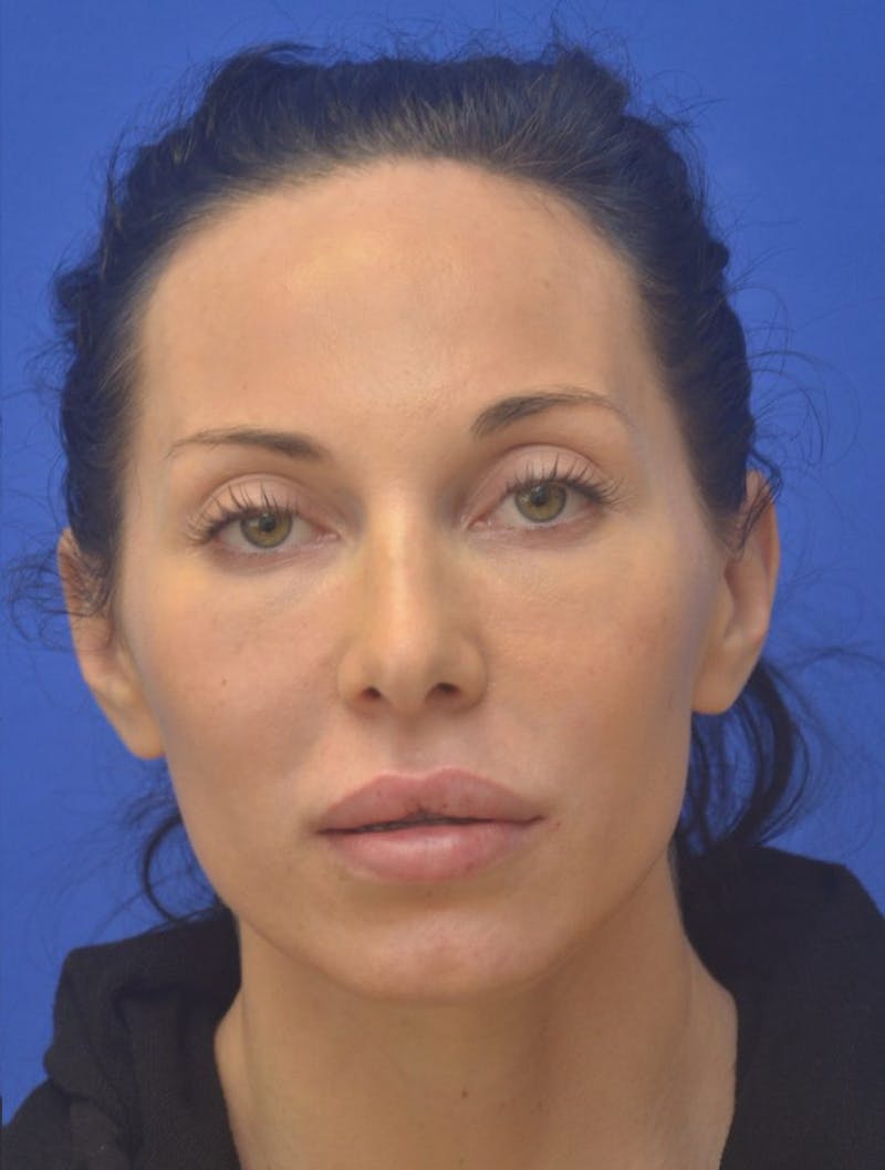 Lip Augmentation Before & After Gallery - Patient 144889 - Image 6