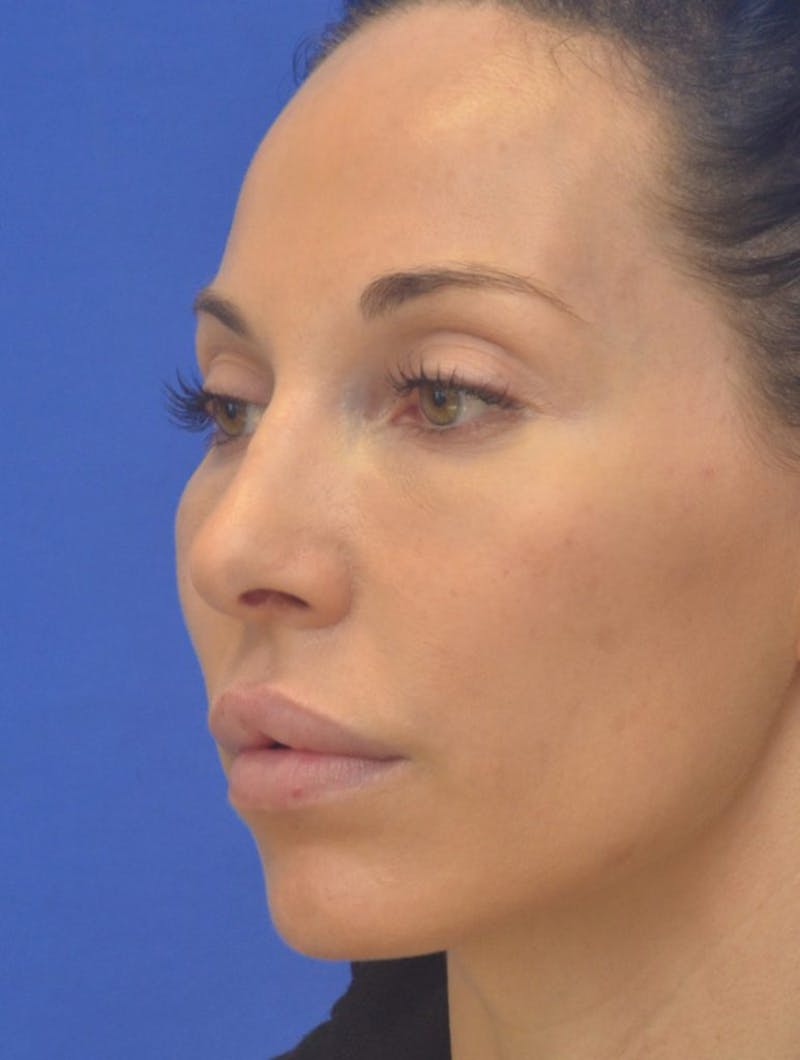 Lip Augmentation Before & After Gallery - Patient 144889 - Image 7