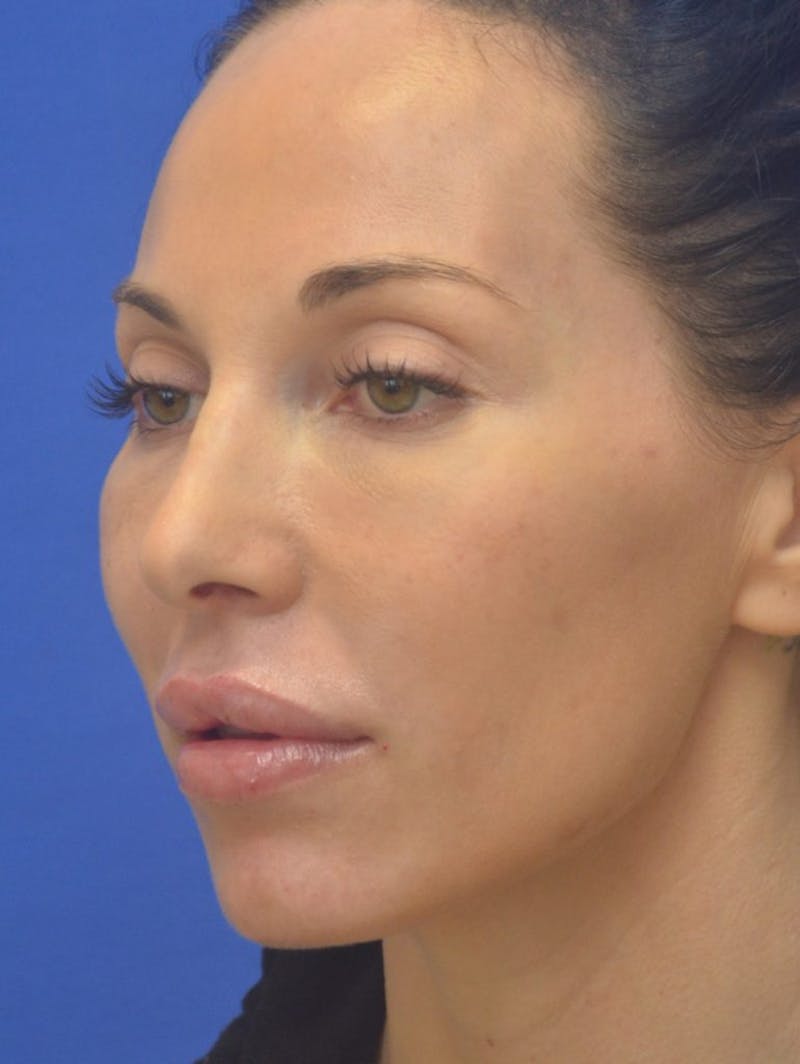 Lip Augmentation Before & After Gallery - Patient 144889 - Image 8