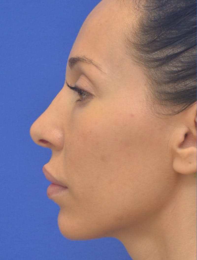 Lip Augmentation Before & After Gallery - Patient 144889 - Image 9
