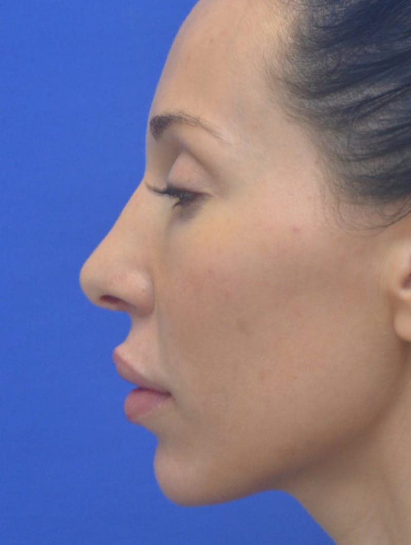 Lip Augmentation Before & After Gallery - Patient 144889 - Image 10
