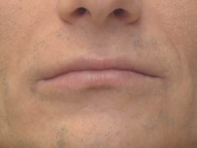 Lip Augmentation Before & After Gallery - Patient 103009 - Image 1