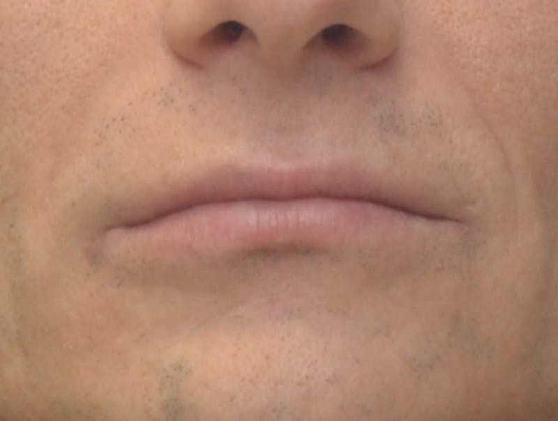 Lip Augmentation Before & After Gallery - Patient 103009 - Image 1