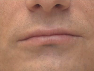 Lip Augmentation Before & After Gallery - Patient 103009 - Image 2