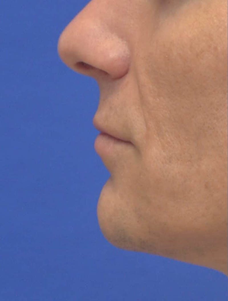 Lip Augmentation Before & After Gallery - Patient 103009 - Image 3