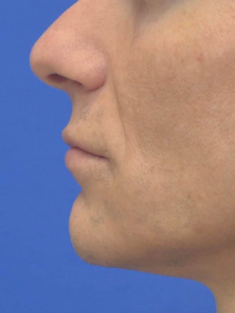 Lip Augmentation Before & After Gallery - Patient 103009 - Image 4