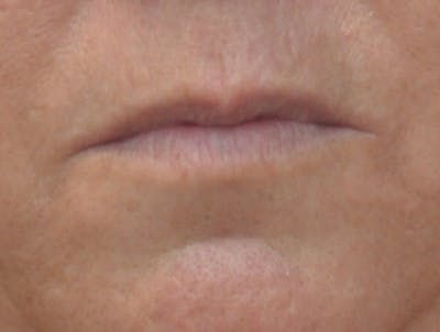 Lip Augmentation Before & After Gallery - Patient 604919 - Image 1