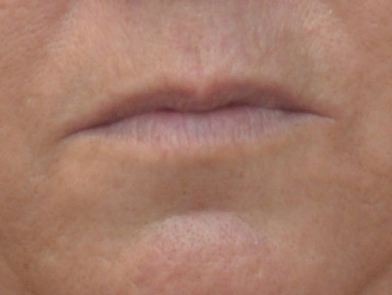 Lip Augmentation Before & After Gallery - Patient 604919 - Image 1