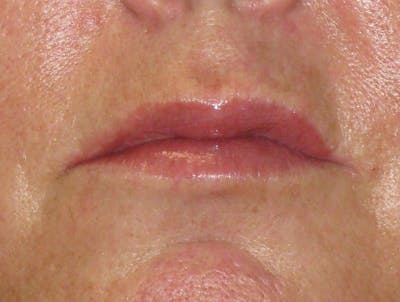 Lip Augmentation Before & After Gallery - Patient 604919 - Image 2