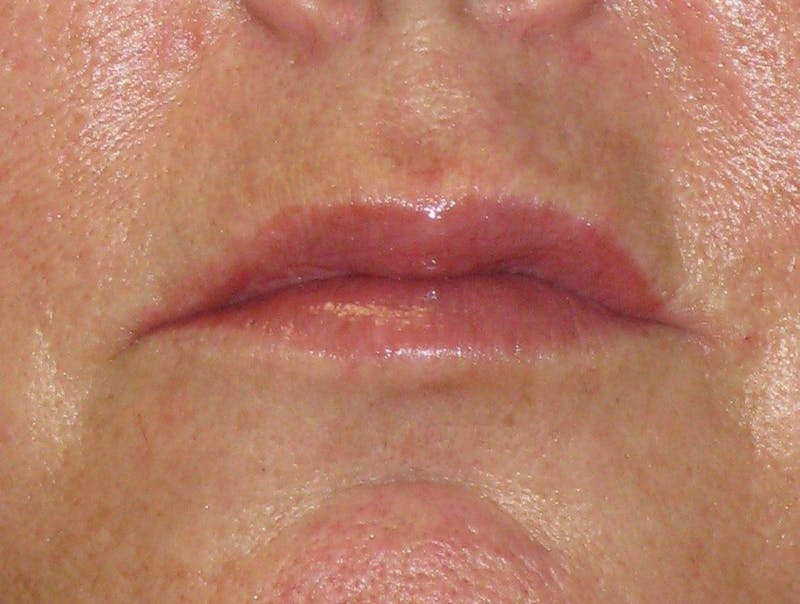 Lip Augmentation Before & After Gallery - Patient 604919 - Image 2