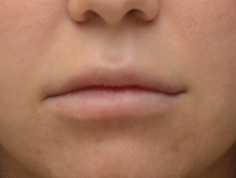 Lip Augmentation Before & After Gallery - Patient 135189 - Image 1
