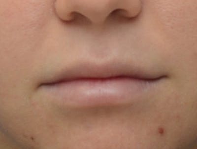 Lip Augmentation Before & After Gallery - Patient 135189 - Image 2