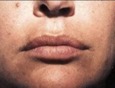 Lip Augmentation Before & After Gallery - Patient 268118 - Image 1
