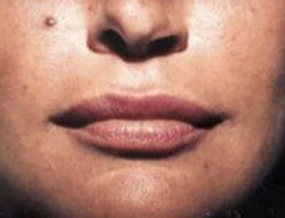 Lip Augmentation Before & After Gallery - Patient 268118 - Image 2