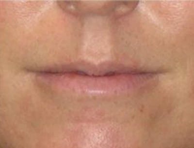 Lip Augmentation Before & After Gallery - Patient 371920 - Image 1