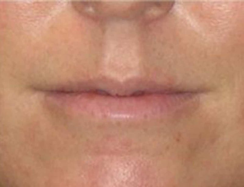 Lip Augmentation Before & After Gallery - Patient 371920 - Image 1
