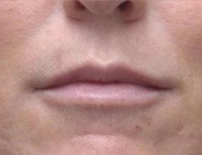 Lip Augmentation Before & After Gallery - Patient 371920 - Image 2