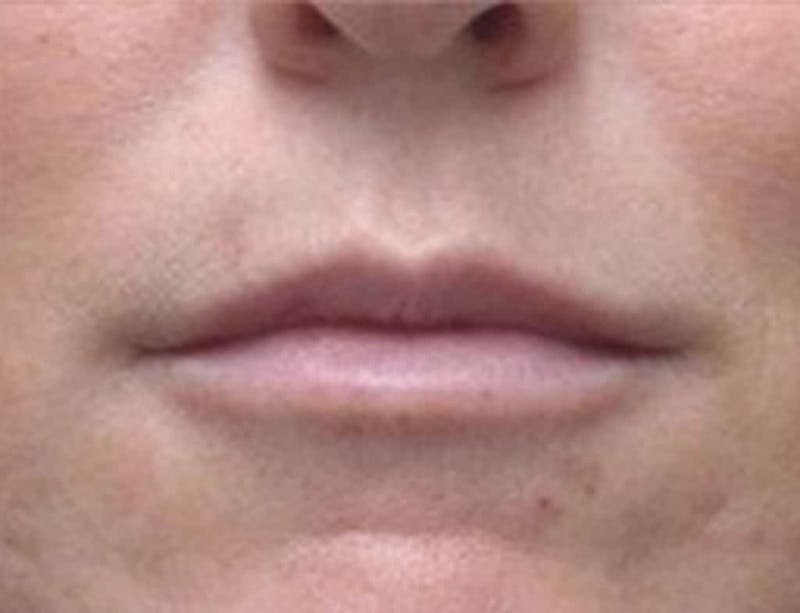 Lip Augmentation Before & After Gallery - Patient 371920 - Image 2