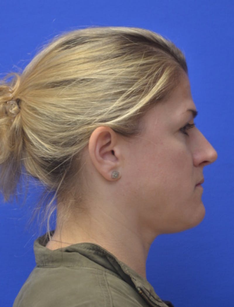 Rhinoplasty Before & After Gallery - Patient 344611 - Image 1