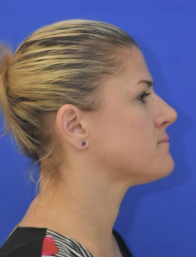 Rhinoplasty Before & After Gallery - Patient 344611 - Image 2