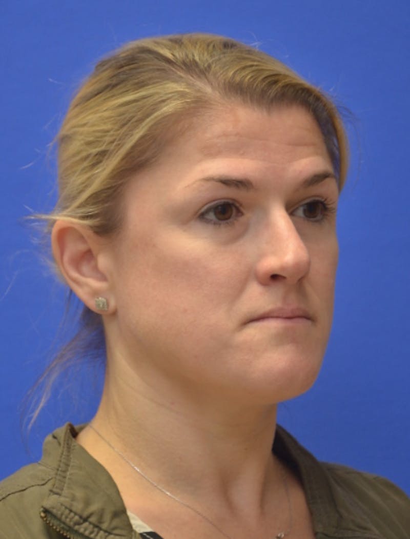 Rhinoplasty Before & After Gallery - Patient 344611 - Image 3