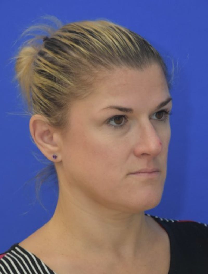 Rhinoplasty Before & After Gallery - Patient 344611 - Image 4