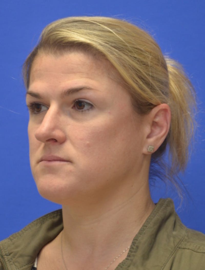 Rhinoplasty Before & After Gallery - Patient 344611 - Image 5