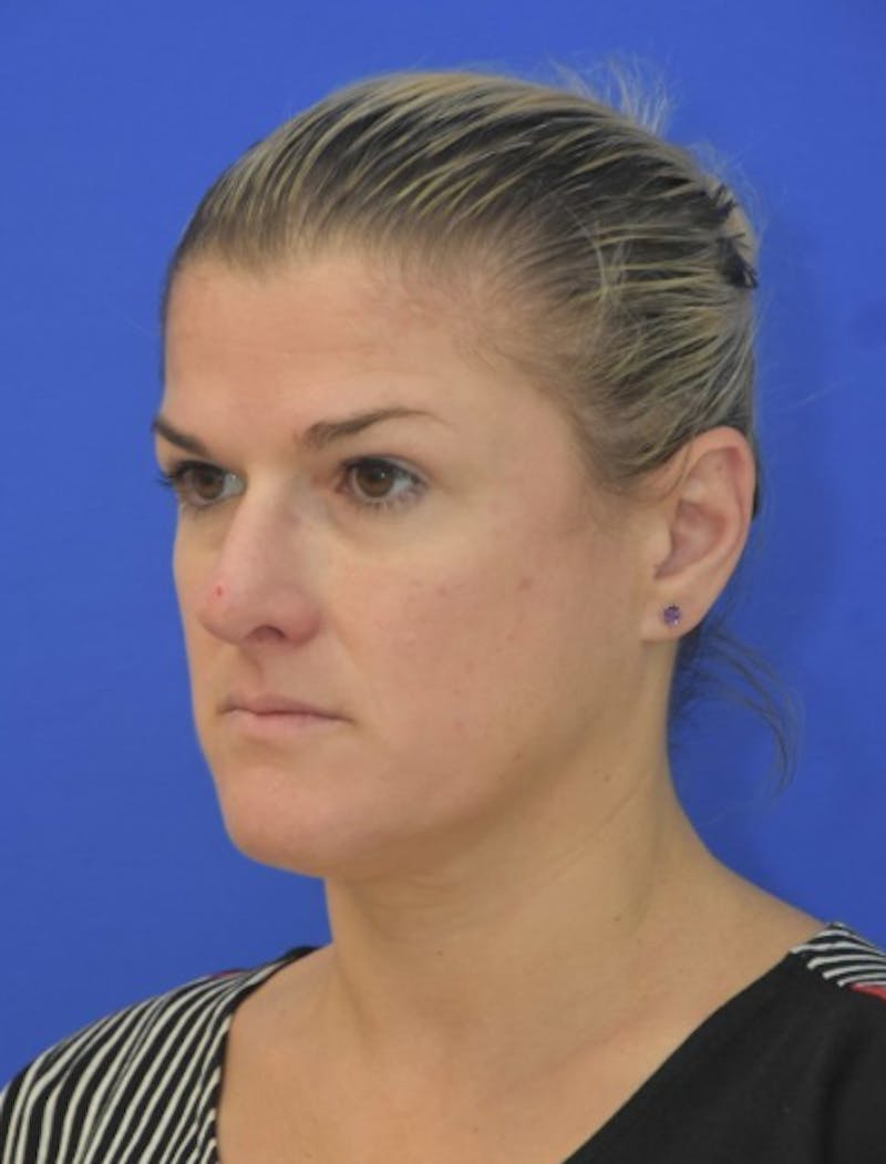 Rhinoplasty Before & After Gallery - Patient 344611 - Image 6