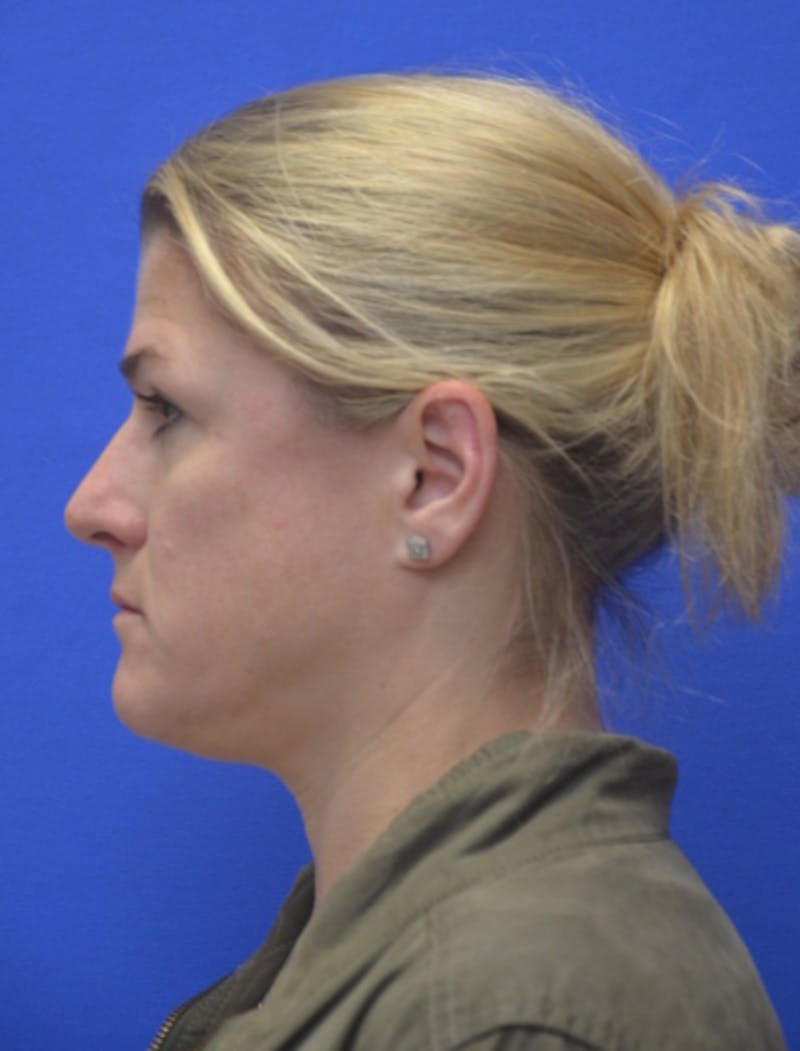 Rhinoplasty Before & After Gallery - Patient 344611 - Image 7