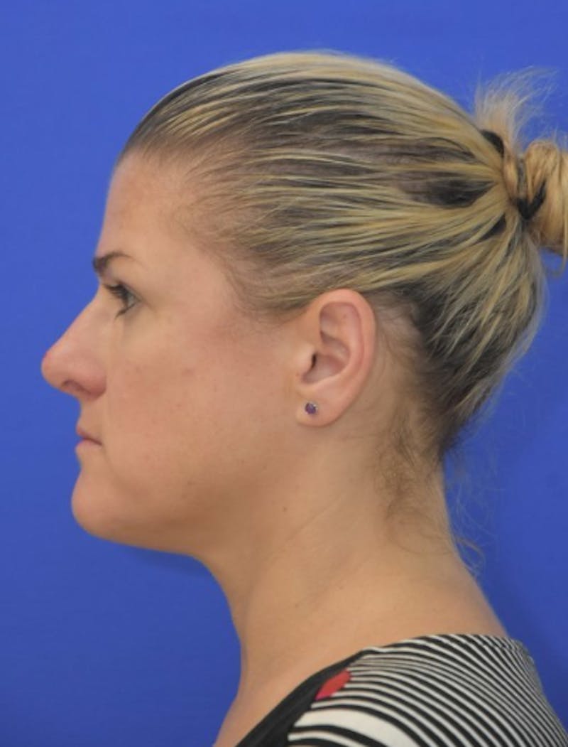 Rhinoplasty Before & After Gallery - Patient 344611 - Image 8