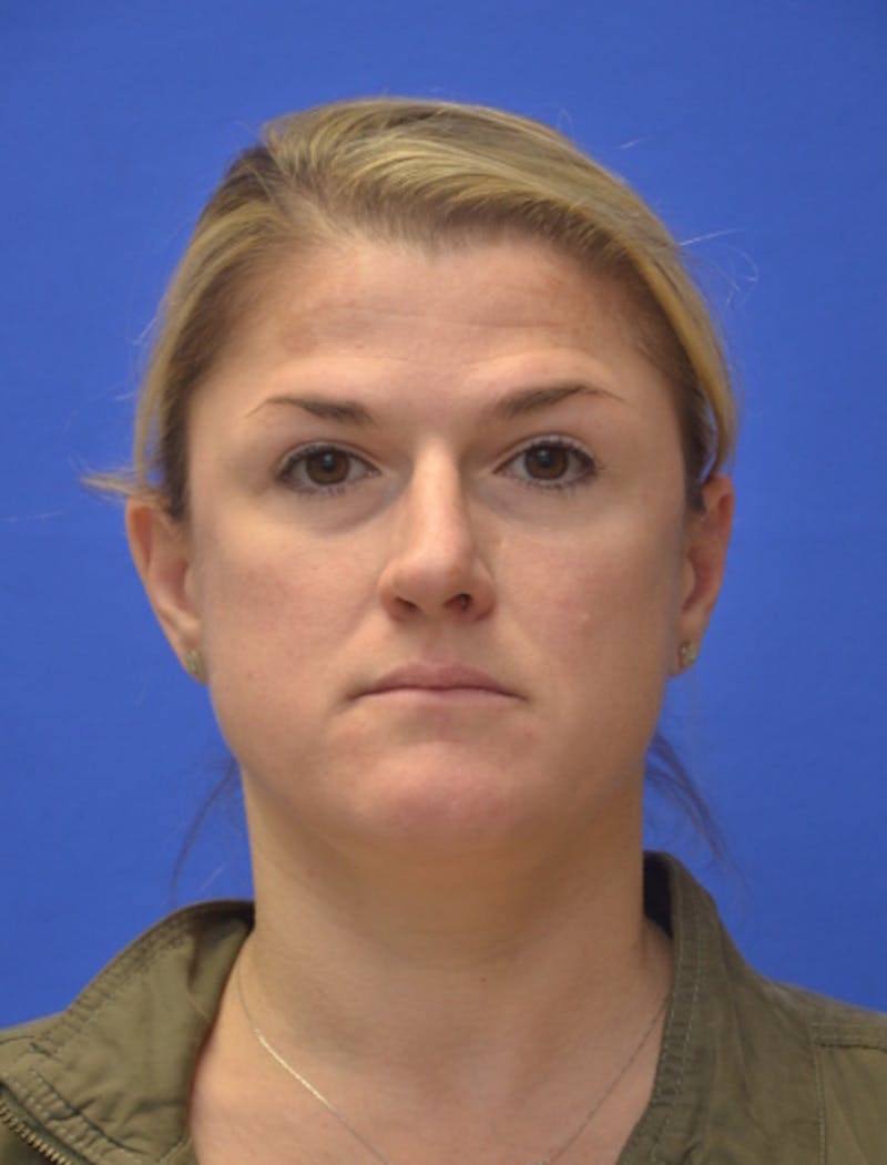 Rhinoplasty Before & After Gallery - Patient 344611 - Image 9