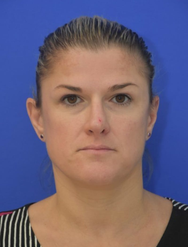 Rhinoplasty Before & After Gallery - Patient 344611 - Image 10