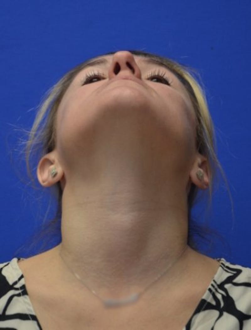 Rhinoplasty Before & After Gallery - Patient 344611 - Image 11