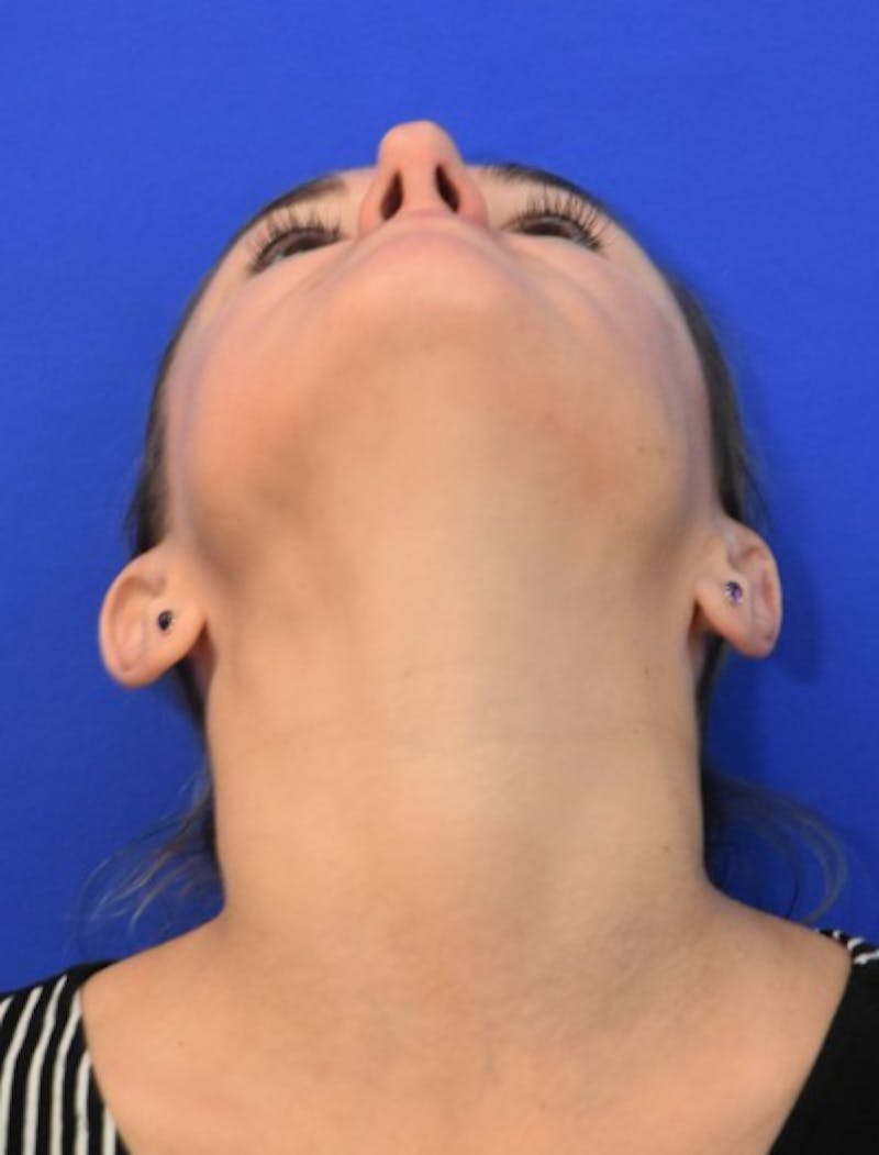 Rhinoplasty Before & After Gallery - Patient 344611 - Image 12
