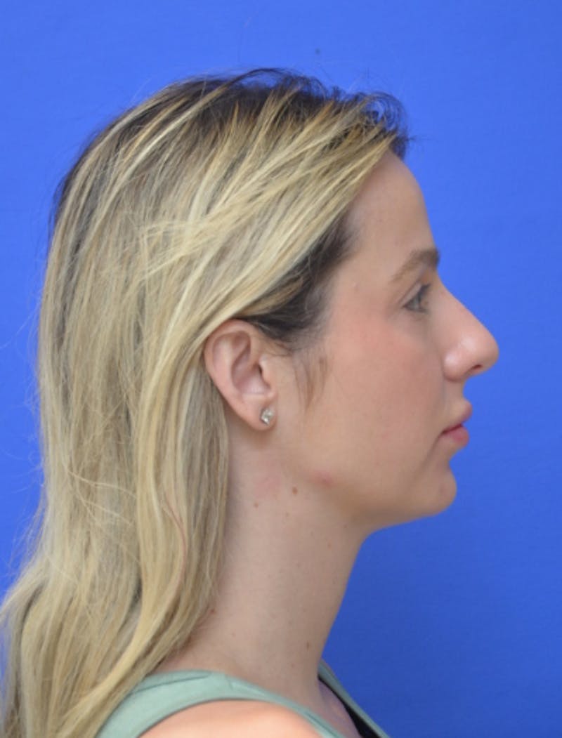 Rhinoplasty Before & After Gallery - Patient 383704 - Image 1