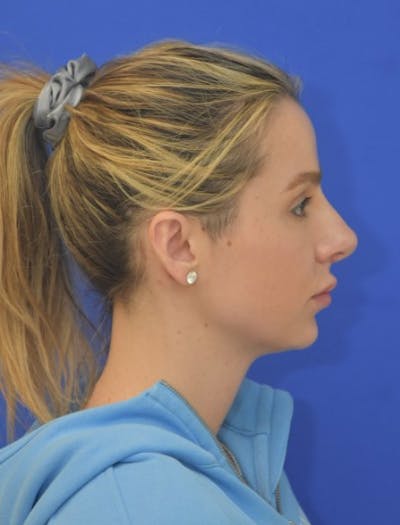 Rhinoplasty Before & After Gallery - Patient 383704 - Image 2