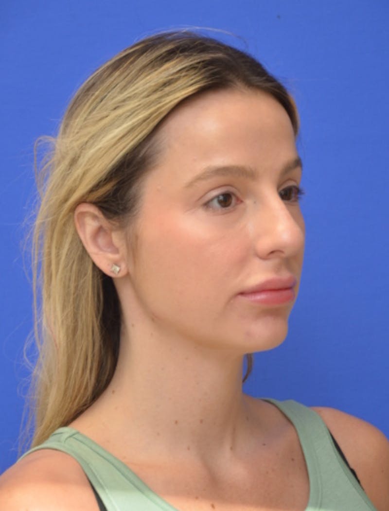 Rhinoplasty Before & After Gallery - Patient 383704 - Image 3